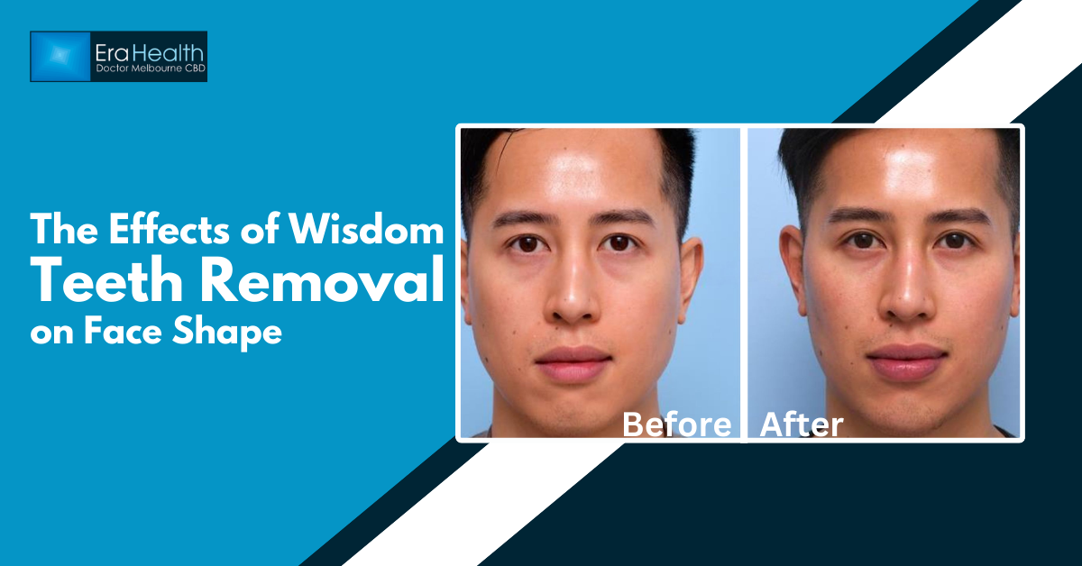 Wisdom Teeth Removal