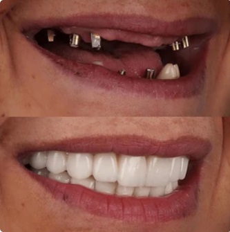 Before and after photo of someone who has had dental implants.